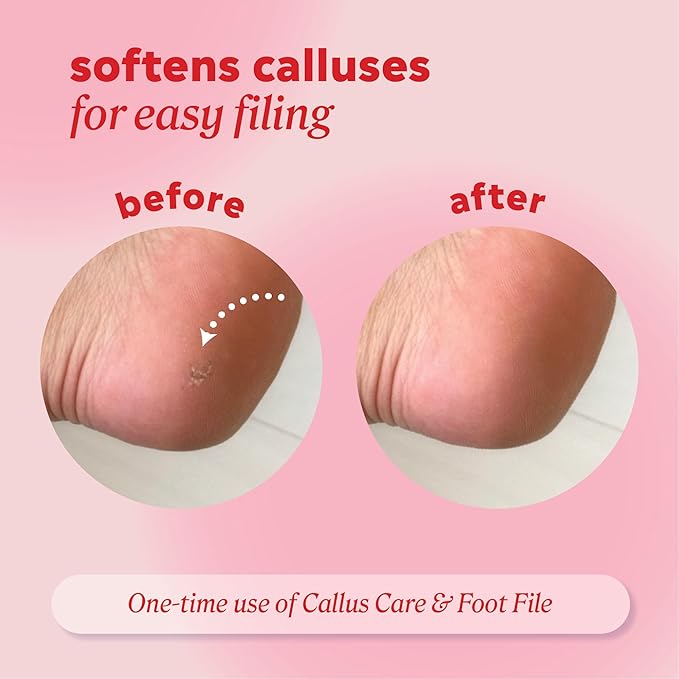 Onyx Professional Callus and Corn Peeling Gel, 4 fl oz - Removes Unwanted Calluses in 3-5 Minutes, Hydrating and Softening Heel Callus Remover for Feet