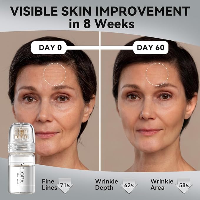 Micro Infusion System for Face - Hydrating Peptide & Hyaluronic Acid Serum Set, Skin-Smoothing Radiance Set with 0.25mm Stamp, At-Home Facial Kit, 1 Month (3 Month Supply)