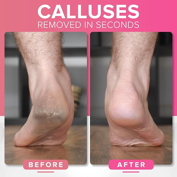 Pedicure Rasp for Dry Hard Skin - Effective Foot File Genuine MEGAFILE Heel Care Callus Remover Dry Dead Skin Egg Corn Sander Scrubber Pumice Stone Alternative Ped Pedi Grater Files Add on Item