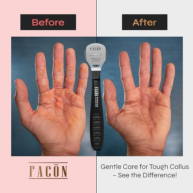 Facón Professional Callus Shaver Remover with 50 Blades, Pedicure Razor for Feet & Hands, Foot Razor for Callus Removal, Callus Blade Remover, Corn Shaver, Surgical Grade Premium Stainless Steel Tool