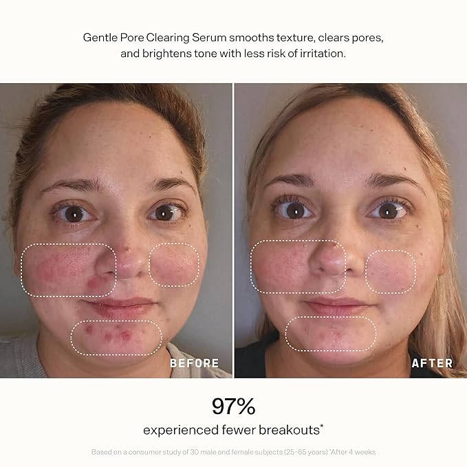 VERSED Skin Refine Gentle Pore Clearing Serum | Exfoliating Facial Serum with Salicylic Acid and Mandelic Acid for Clear Skin | Safe for Sensitive Skin, Vegan, 30 ml / 1 fl oz