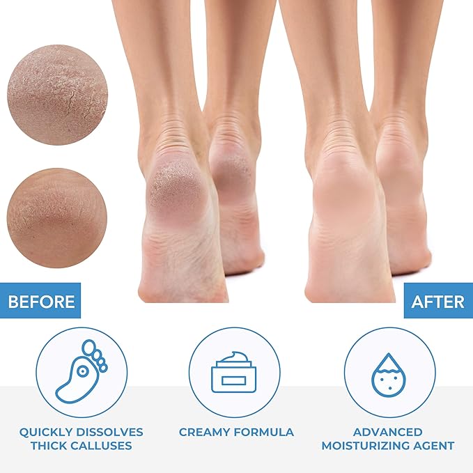 ForPro Professional Collection Premium Callus No More! Callus Remover, Fast-Acting Callus Removing Formula, 32 oz. (Pack of 2)