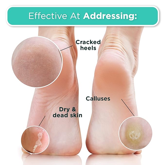 DERMORA Foot Peel Mask | Skin Exfoliating Foot Masks for Dry, Cracked Feet & Callus Removal | Dead Skin Exfoliator for Baby Soft Feet | Pack of 4 | Regular (Fits up to Men 10 / Women 11) | Original