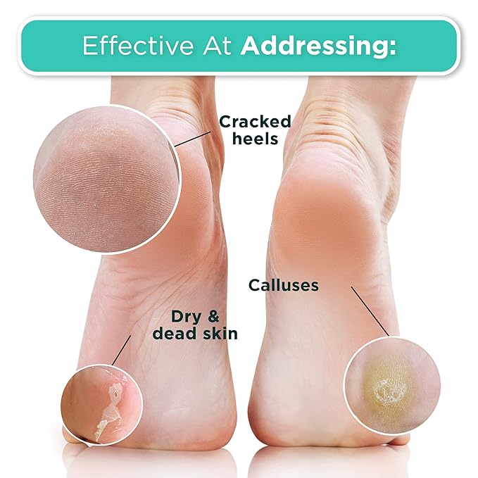DERMORA Foot Peel Mask | Skin Exfoliating Foot Masks for Dry, Cracked Feet & Callus Removal | Dead Skin Exfoliator for Baby Soft Feet | Pack of 2 | Regular (Fits up to Men 10 / Women 11) | Tea Tree
