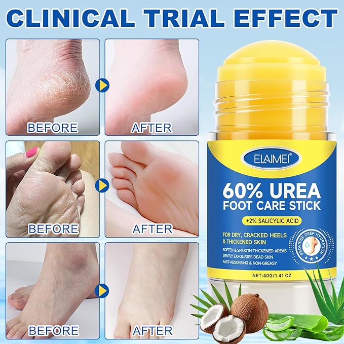 Urea Cream Stick 60% + 2% Salicylic Acid, Foot & Hand Balm for Dry, Cracked Heels & Rough Skin, 60 Percent Urea Lotion for Feet Maximum Strength,Callus Remover & Skin Softener, Soften Dead Skin1.4 oz