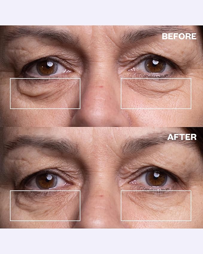 Wrinkles Schminkles Under Eye Wrinkle Patches, Smooth Eye Wrinkles, Crows Feet & Dark Circles Overnight, 1 Pair Reusable Medical Grade Silicone Patches