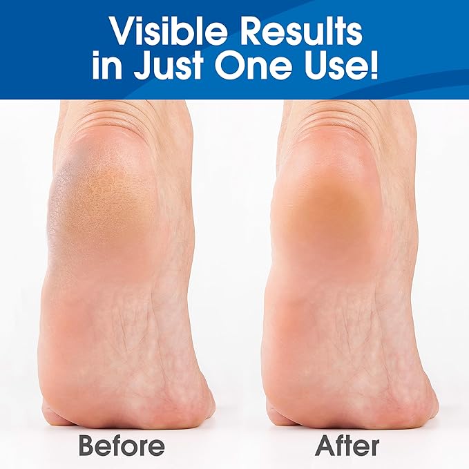 DeEnti Callus Remover for Feet, Extra Strength Foot Callus Remover Gel, 128oz Gallon Salon Grade Bulk Pedicure Supplies for Dry Skin, Cracked Heel, Professional Strength Foot Care, Unscented