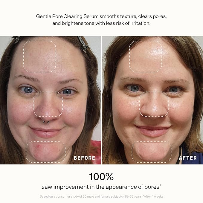 VERSED Skin Refine Gentle Pore Clearing Serum | Exfoliating Facial Serum with Salicylic Acid and Mandelic Acid for Clear Skin | Safe for Sensitive Skin, Vegan, 30 ml / 1 fl oz