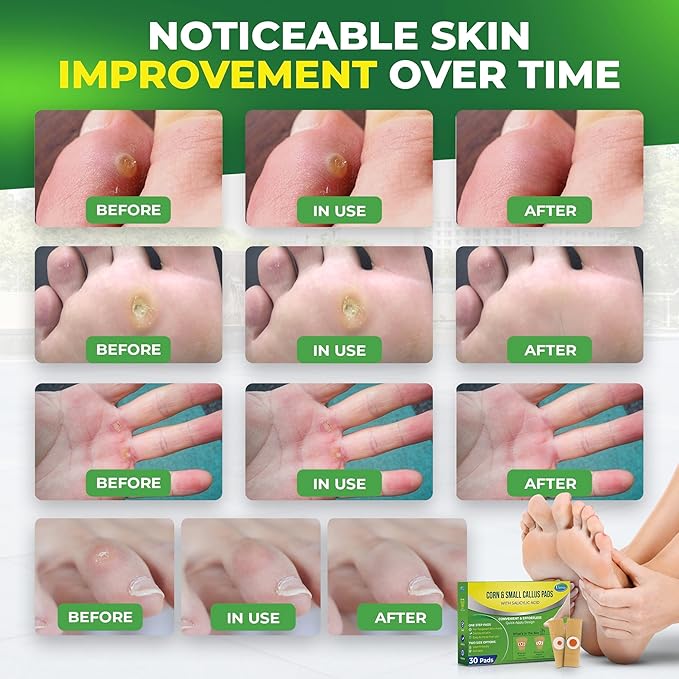 Ulensy Corn Remover Pads for Feet Toes: 30-Pack Salicylic Acid Extra Strength Treatment - Fast Effective Medicated Bandages for Kids Adults Seniors Teens Athletes Runners Hikers Workers Men Women